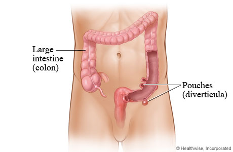 Pouches (diverticula) in the large intestine (colon)