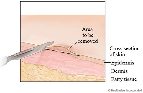Shave skin biopsy