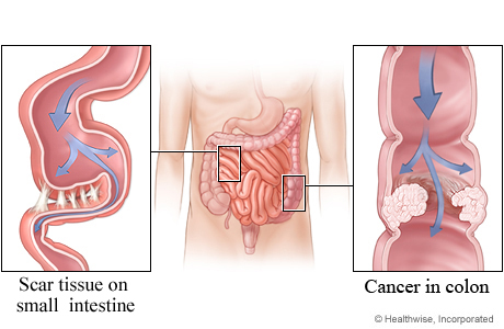 Obstructions in the small and large intestines.