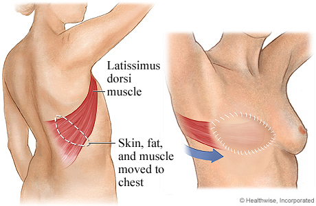 Latissimus dorsi flap for breast reconstruction