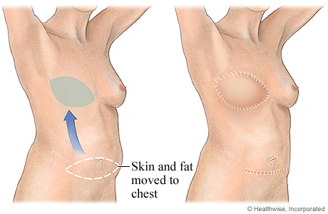DIEP flap for breast reconstruction