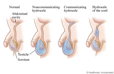 Three types of hydroceles