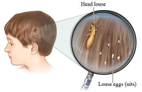 How head lice and their eggs (nits) look on hair