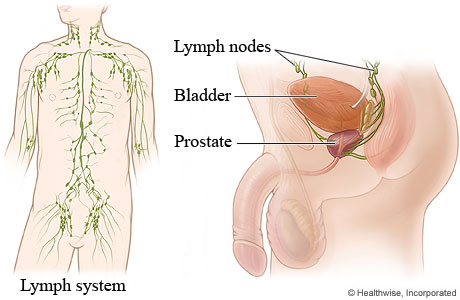 Picture of lymph nodes in the male retroperitoneum and pelvis
