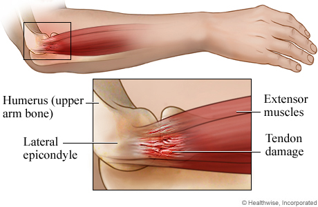 Tennis elbow anatomy: side view