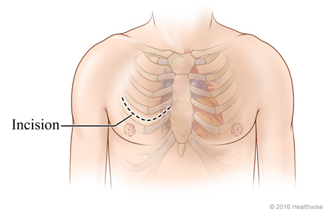 Chest incision site across chest between two ribs.