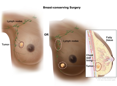 Breast-conserving surgery; the drawing on the left shows removal of the tumor and some of the normal tissue around it. The drawing on the right shows removal of some of the lymph nodes under the arm and removal of the tumor and part of the chest wall lining near the tumor. Also shown is fatty tissue in the breast.