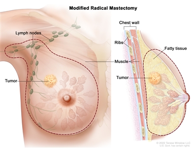 Modified radical mastectomy; the drawing on the left shows the removal of the whole breast, including the lymph nodes under the arm. The drawing on the right shows a cross-section of the breast, including the fatty tissue and chest wall (ribs and muscle). A tumor in the breast is also shown.