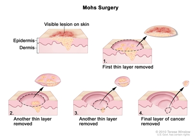 Mohs surgery; drawing shows a visible lesion on the skin. The pullout shows a block of skin with cancer in the epidermis (outer layer of the skin) and the dermis (inner layer of the skin). A visible lesion is shown on the skin's surface. Four numbered blocks show the removal of thin layers of the skin one at a time until all the cancer is removed.