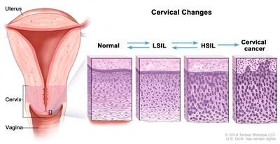 Cervical changes; drawing shows a cross-section of the uterus, cervix, and vagina. Also shown are four panels showing cell changes inside the cervix. The first panel shows normal cells. The second and third panels show abnormal cells called LSIL and HSIL. The fourth panel shows cervical cancer cells. Arrows are used between the panels to show that normal cells may become LSIL or HSIL, which may or may not become cancer.