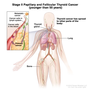 Stage II papillary and follicular thyroid cancer in patients younger than 55 years; drawing shows other parts of the body where thyroid cancer may spread, including the lung and bone. An inset shows cancer cells spreading from the thyroid gland, through the blood and lymph system, to another part of the body where metastatic cancer has formed.