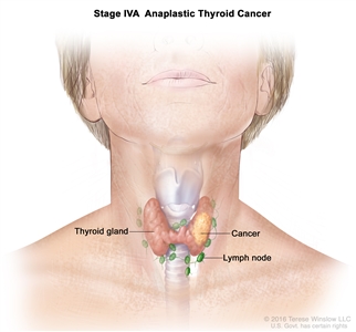 Stage IVA anaplastic thyroid cancer; drawing shows cancer in the thyroid gland. The lymph nodes are also shown.