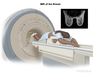 MRI of the breast; drawing shows a person lying face down on a narrow, padded table with their arms above their head. The person's breasts hang down into an opening in the table. The table slides into the MRI machine, which takes detailed pictures of the inside of the breast. An inset shows an MRI image of the insides of both breasts.