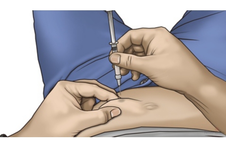 How to Give a Subcutaneous Injection