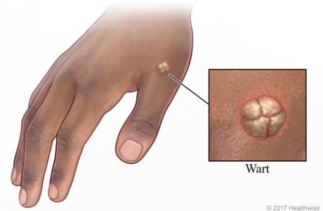 Common wart on hand, with close-up of wart