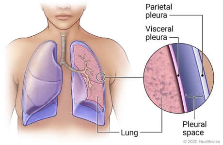 Inside view of pleura around lungs with detail of visceral pleura, pleural space, and parietal pleura outside of lung.