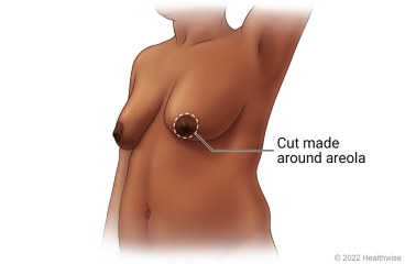 Breast showing incision site for skin-sparing mastectomy with periareolar cut, a cut made all around the areola.