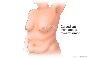 Breast showing incision site for nipple-sparing mastectomy, a curved cut from areola toward armpit.