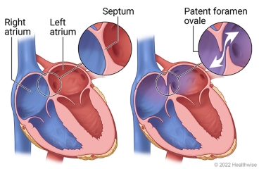 Inside view of right atrium and left atrium of heart, with details showing a normal septum and one with patent foramen ovale.