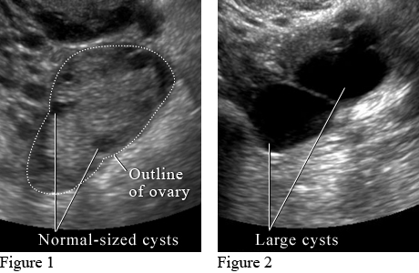 Ultrasound images of ovarian cysts