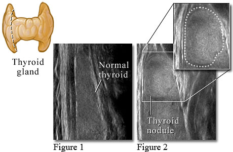Ultrasound image of a normal thyroid and one with a thyroid nodule