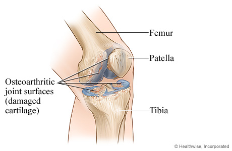 Knee joint with osteoarthritis