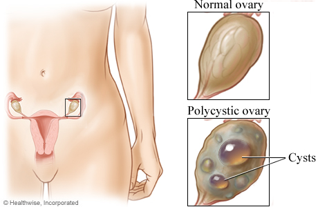 Location of the ovaries with closeup of a normal ovary and a polycystic ovary