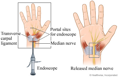 Endoscopic carpal tunnel release surgery