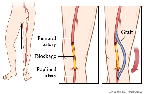 Blocked artery and position of graft in femoropopliteal bypass