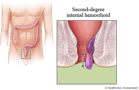 Picture of a second-degree internal hemorrhoid