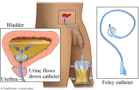 Foley catheter
