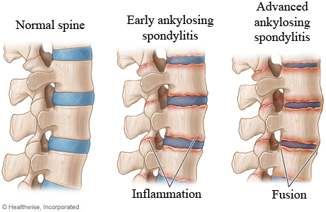 The stages of ankylosing spondylitis in the spine.