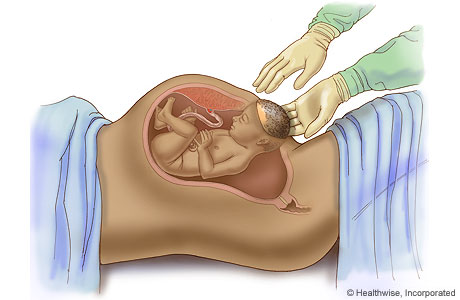 Cesarean delivery