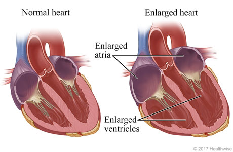 Inside view of a normal heart and a heart with chambers larger than normal