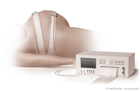 External electronic fetal monitoring.