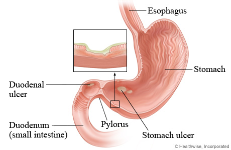 Peptic ulcers in the stomach and duodenum
