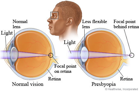 What causes presbyopia (blurred near vision)
