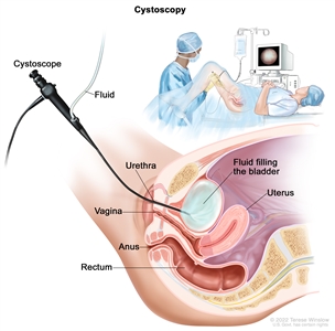 Cystoscopy; drawing shows a side view of the lower pelvis containing the bladder, uterus, vagina, rectum, and anus. A cystoscope (a thin, tube-like instrument with a light and a lens for viewing) is shown passing through the urethra and into the bladder. Fluid is used to fill the bladder. An inset shows a woman lying on an examination table with her knees bent and legs apart. She is covered by a drape. The doctor is looking at an image of the inner wall of the bladder on a computer monitor to check for abnormal areas.
