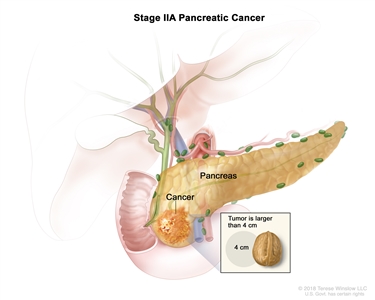 Stage IIA pancreatic cancer; drawing shows cancer in the pancreas and the tumor is larger than 4 centimeters. An inset shows 4 centimeters is about the size of a walnut.
