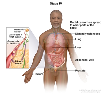 Stage IV rectal cancer; drawing shows other parts of the body where rectal cancer may spread, including the distant lymph nodes, lung, liver, abdominal wall, and prostate. An inset shows cancer cells spreading from the rectum, through the blood and lymph system, to another part of the body where metastatic cancer has formed.