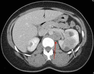 Axial view of an individual's midsection showing tumors in both kidneys. The left kidney has a small tumor and the right kidney has a larger tumor. A retroperitoneal lymph node is shown beside the larger tumor.