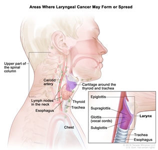 Drawing shows areas where laryngeal cancer may form or spread, including the supraglottis, glottis (vocal cords), subglottis, thyroid, trachea, and esophagus. Also shown are the epiglottis, the upper part of the spinal column, the carotid artery, the cartilage around the thyroid and trachea, lymph nodes in the neck, and the chest.