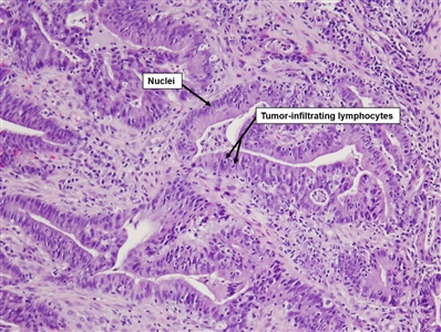 Histopathology slide of a colorectal tumor under a microscope, showing lymphocytes and cell nuclei in the tumor.