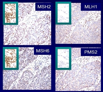 Protein stains of normal and colorectal tumor tissue are shown for a single patient. The stains from the tumor (in four insets) show the presence of MSH2 and MSH6 (the dark stain is visible) and absence of MLH1 and PMS2 (the dark stain is not visible).