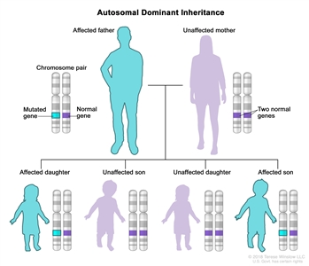 Drawing showing an autosomal dominant inheritance pattern between a father, mother, and their four children: a chromosome pair with a normal gene and a mutated gene in an affected father; two normal genes in an unaffected mother; a normal gene and a mutated gene in an affected daughter and in an affected son; and two normal genes in an unaffected daughter and in an unaffected son.