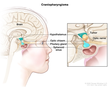 Drawing of the inside of the brain showing where craniopharyngiomas may form. A pullout shows a tumor between the hypothalamus and the optic chiasm. Also shown is the optic nerve, the pituitary gland, and the sphenoid sinus.
