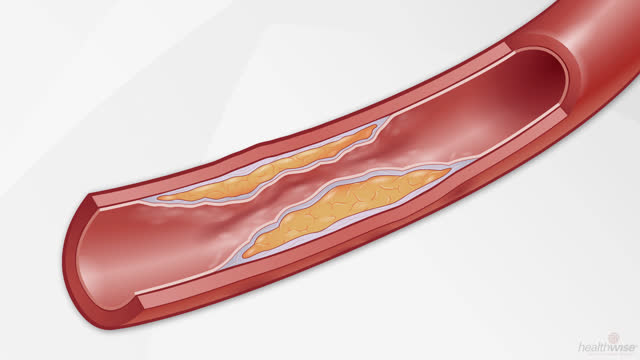 Cholesterol: How It Raises Your Risk