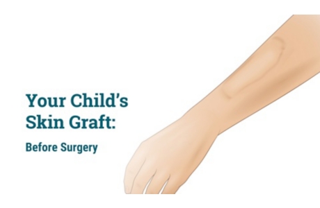Your Child's Skin Graft: Before Surgery