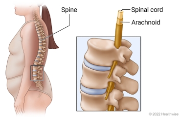 Location of the spine, with close-up view of the spinal cord surrounded by the arachnoid membrane.