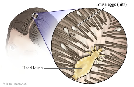 Lice in a person's hair part, with close-up of louse and louse eggs (nits).